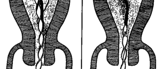 Экспульсия внутриматочной спирали
