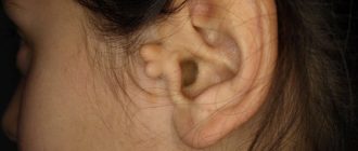 Дополнительная ушная раковина