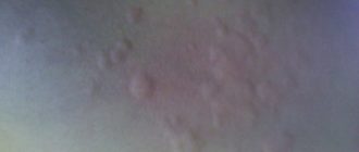 Волдыри на теле надуваются, потом проходят