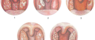 Налет на горле без температуры