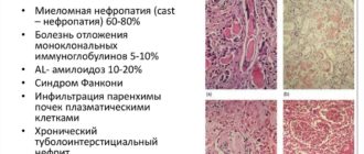 Миеломная болезнь с поражением почек