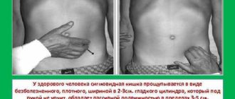 Дискомфорт в районе сигмовидной и прямой кишки при пальпации