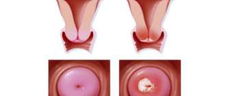 Может ли кровить эрозия