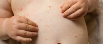 Ветрянка сыпь