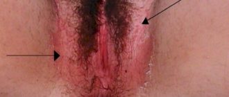 Чешется промежность после ПА
