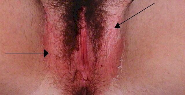 Чешется промежность после ПА