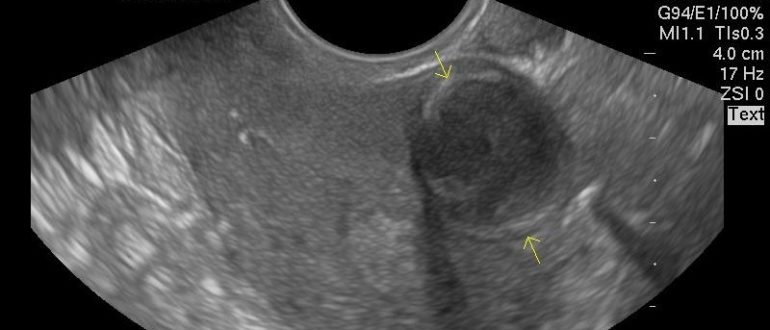 Миома 11 недель