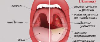 Месяц кашель, бактерии и белый налет в горле