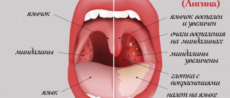 Месяц кашель, бактерии и белый налет в горле