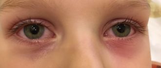 Чешутся глаза у ребенка