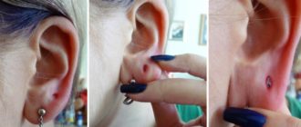 Воспалилась мочка уха от ношения серёжек