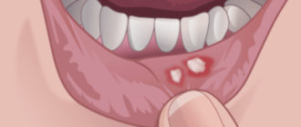 Воспаление во рту