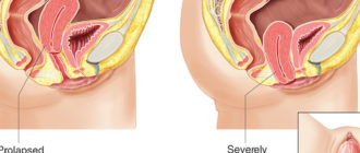 Дискомфорт во влагалище после слишком активного секса