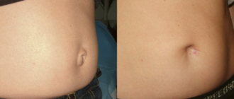 Дискомфорт после удаления пупочной грыжи