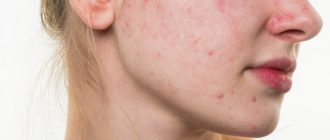 Нарушение цикла, прыщи