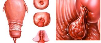 Нарушение цикла после удаления полипа цервикального канала