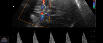 Нарушение кровотока в сма