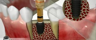 Влияние установки импланта на зрение