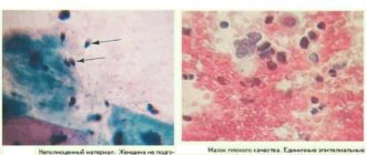 Воспаление и плохой мазок