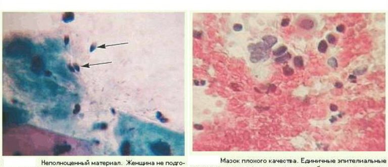 Воспаление и плохой мазок