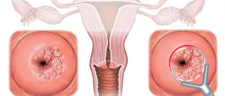 Метаплазия, цервицит, паракератоз, дисфункция яичников, гормональная терапия