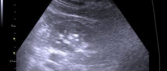 Микролиты в почках