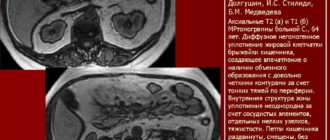 Мезентериальный панникулит насколько опасно?
