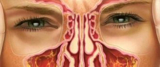Диагноз и лечение, отёк и сильно болит лицо при хроническом гайморите