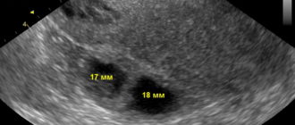 Могли ли перепутать миому с желтым телом?