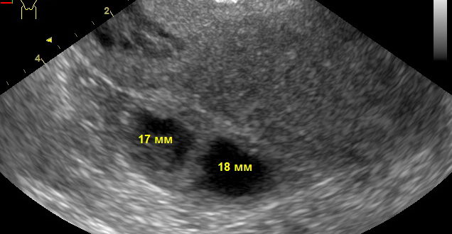 Могли ли перепутать миому с желтым телом?