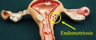 Эндометриоз тела матки