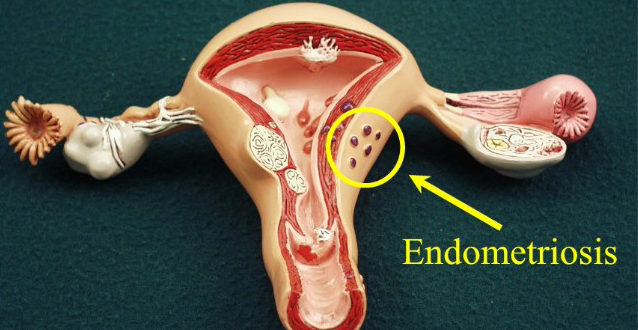 Эндометриоз тела матки