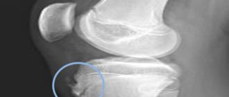 Воспаление бугристости большеберцовой на обеих ногах у взрослого