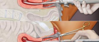 Частое мочеиспускание после мини аборта