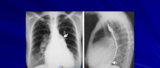 Дилатация левого предсердия