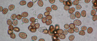 В кале споры и грибы в большом количестве