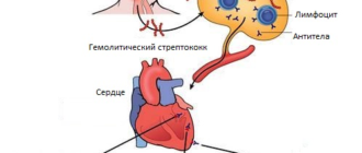 Влияние хронического тонзиллита на сердце