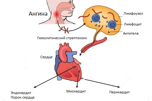Осложнение на сердце после. Патогенез хронического тонзиллита схема. Механизм развития ангины. Влияние ангины на сердце.