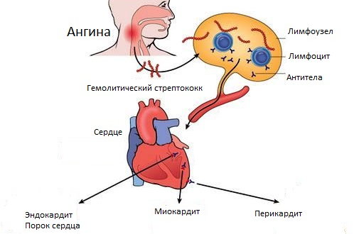 Патогенез ангины. Патогенез хронического тонзиллита схема. Механизм развития ангины. Влияние ангины на сердце.