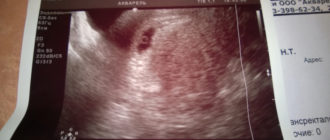 Узи после переноса