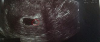 Узи не видит плод