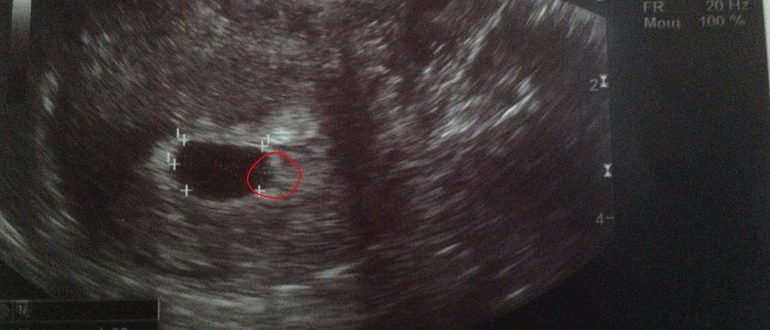 Узи не видит плод