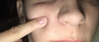 В щеке образовался шарик, немного увеличился, но не болит