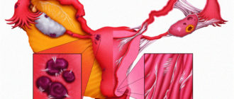 Эндометриоз и спайки