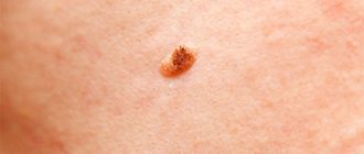 Чешется родинка