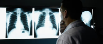 Может ли рентген спровоцировать развие онкологии