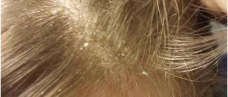 На голове что-то белое как перхоть, но не перхоть
