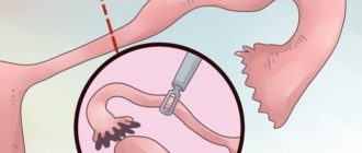 Выделения после удаления трубы