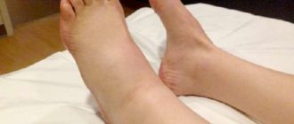 Выпила очень много кофе и отекли стопы ног