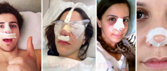 Длительная температура после операции на нос